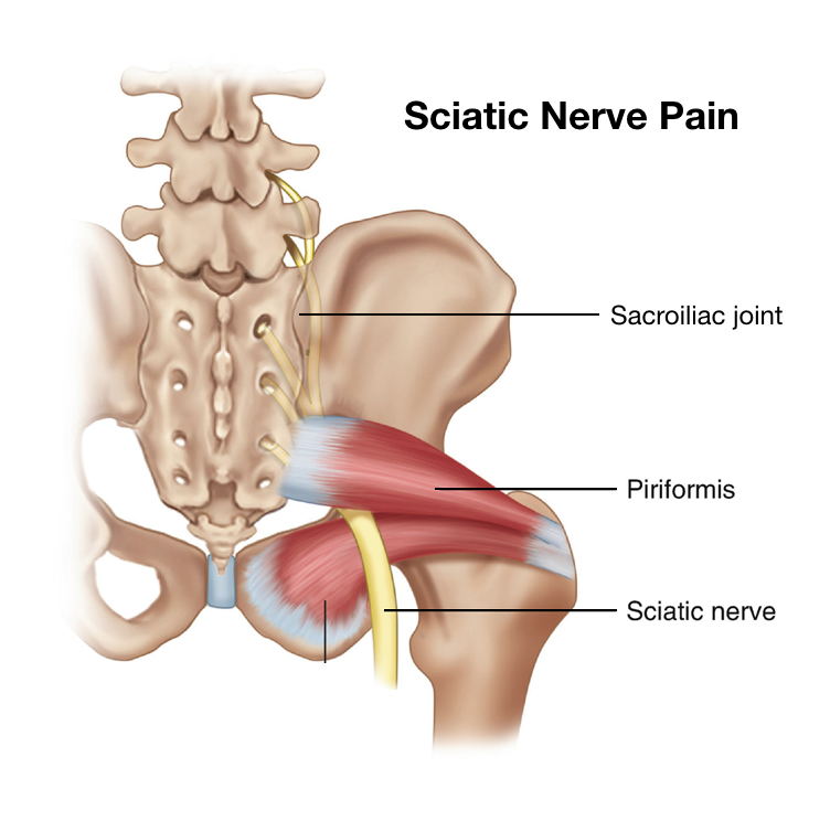 Sciatica and Sciatic Nerve Pain